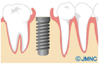インプラントを埋め込む