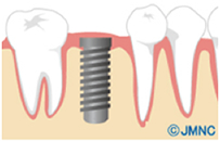 インプラントと骨が結合するまで待つ