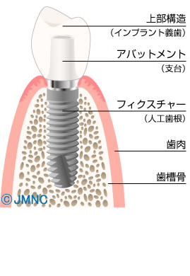 インプラントの構造